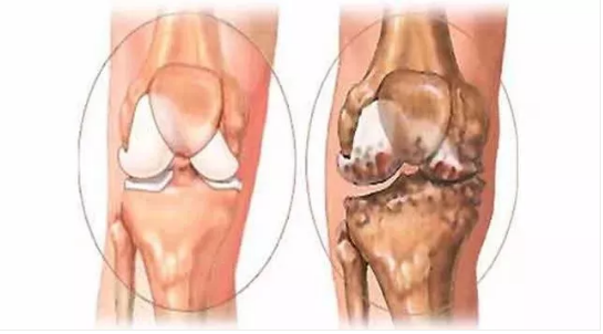 Knees often hurt? Beware of these 6 knee problems